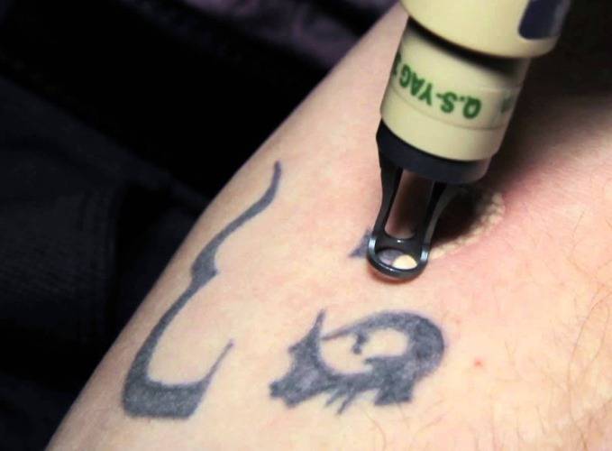 Как вывести татуировку
