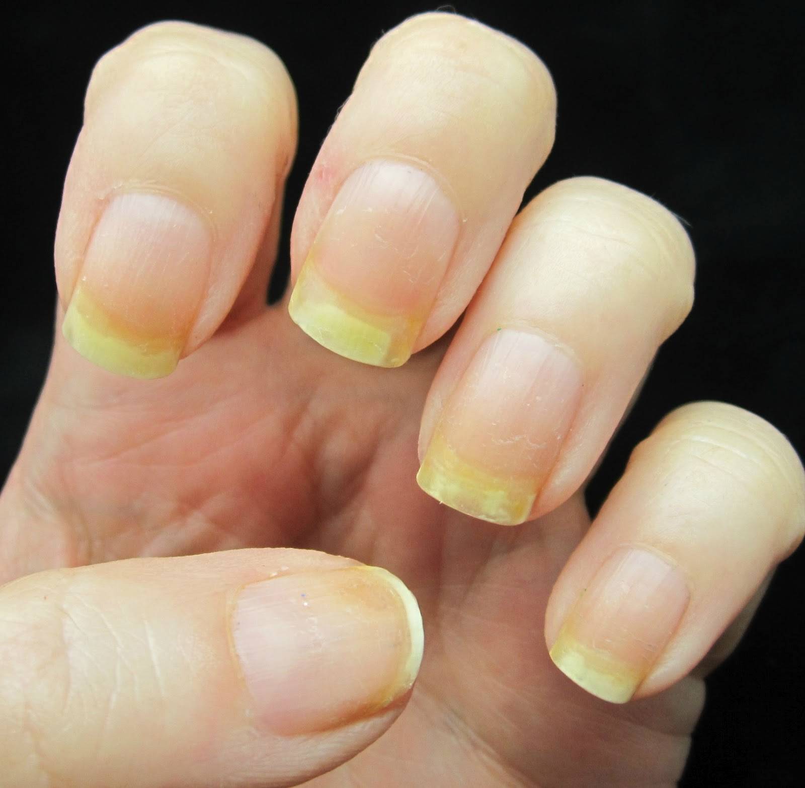 Желтые ногти — причины, болезни, диагностика, профилактика и лечение — likar24