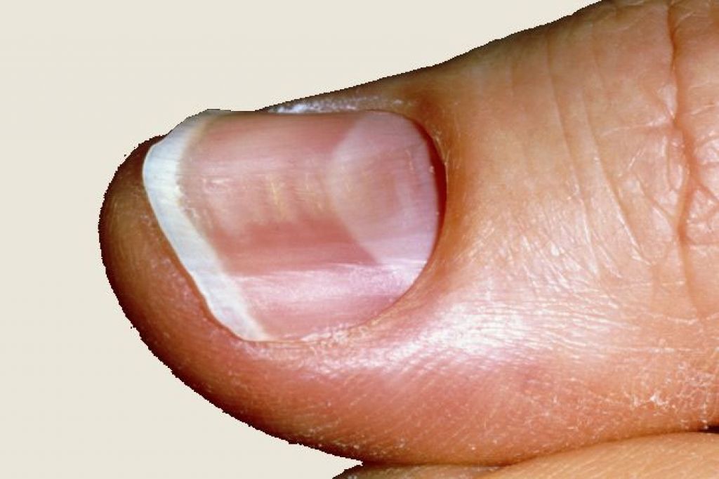 Дистрофия ногтей