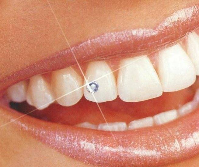 Скайсы или пирсинг зуба- виды, способы крепления, инструкция по установке » womanmirror
скайсы или пирсинг зуба- виды, способы крепления, инструкция по установке
