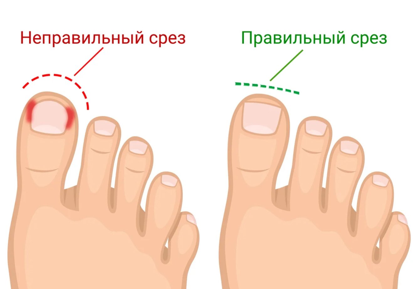 Грибок ногтевой пластины: удалить грибок ногтевой пластины в клинике, платный хирург в москве