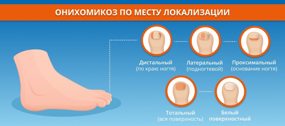 Онихомикоз – заболевание ногтей