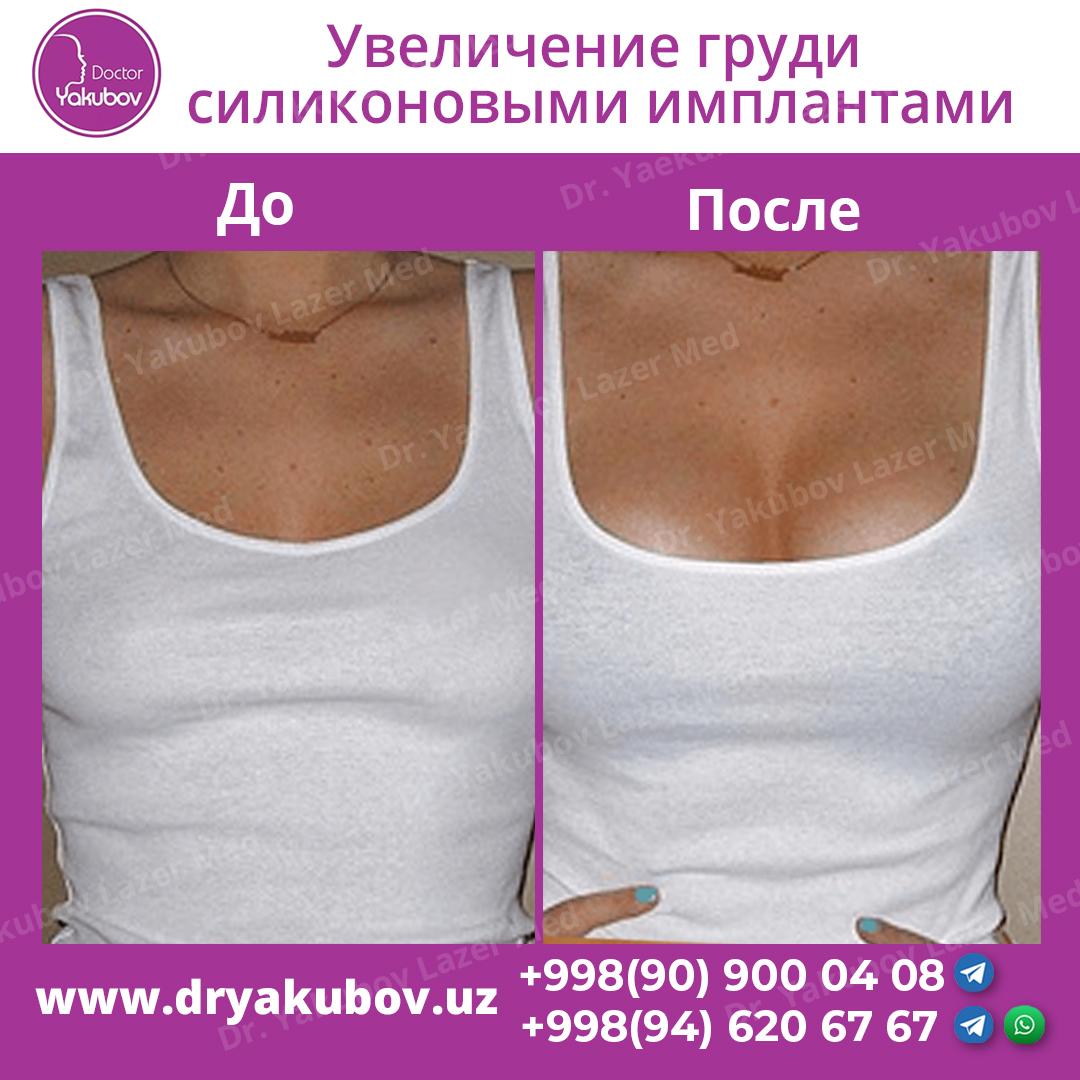 Увеличение груди: современные способы установки имплантов | портал 1nep.ru