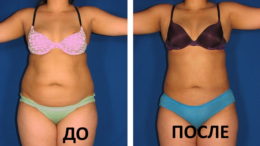Липолитики для живота для похудения. Фото до и после, отзывы