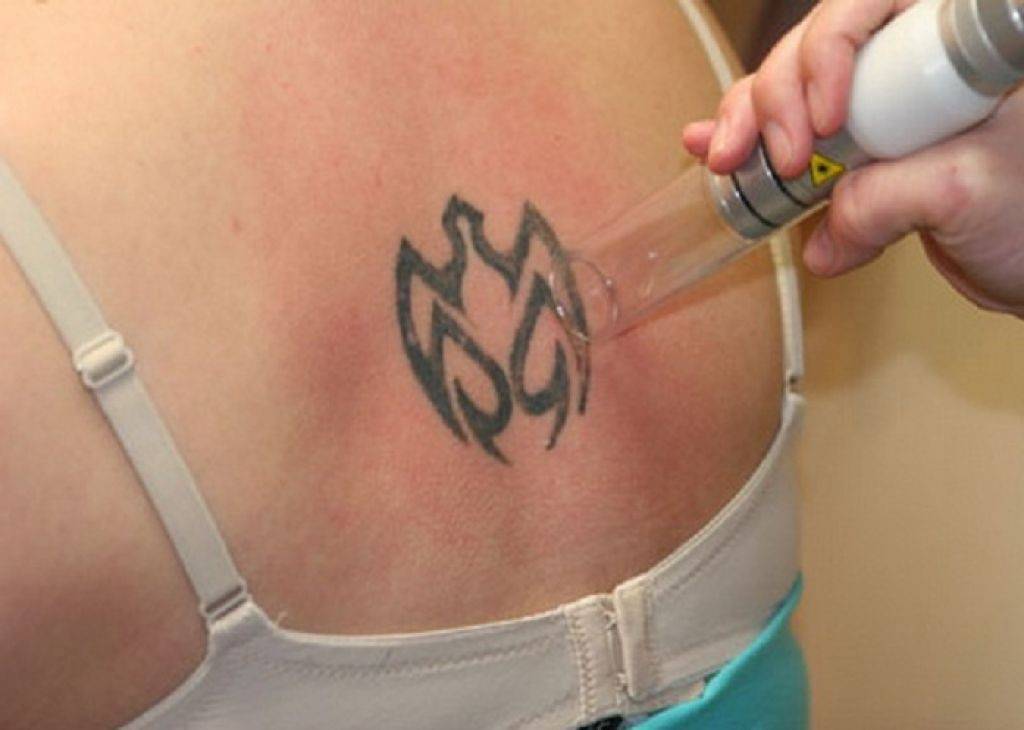 Лазерное удаление татуировки и татуажа