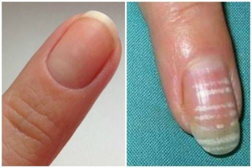 Черные темные пятна на ногтях – в чем причина появления?