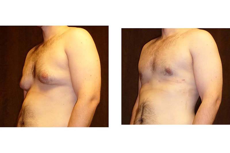 Коррекция тубулярной груди: показания, противопоказания, фото до/после