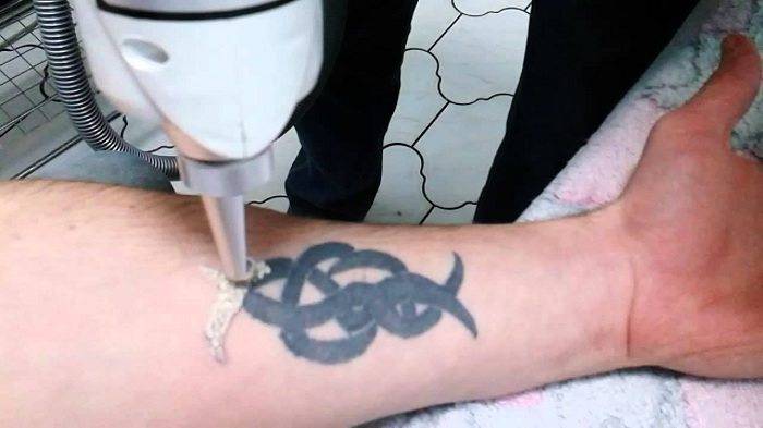 Убить набитое. как удаляют татуировки