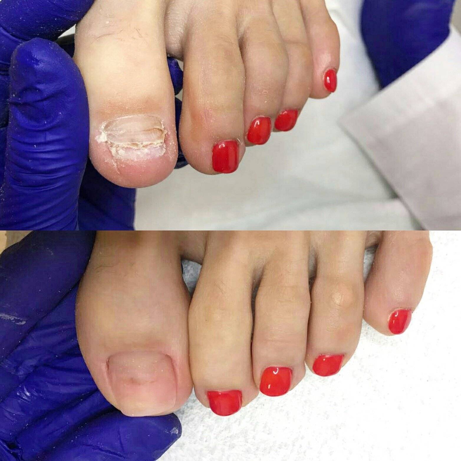 Педикюр нарощенные ногти на ногах