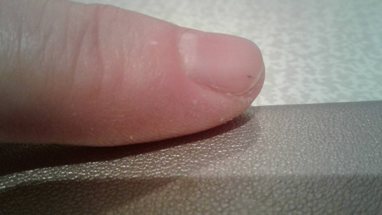Что означает черная точка или пятно на ногте? причины появления, способы лечения, фото