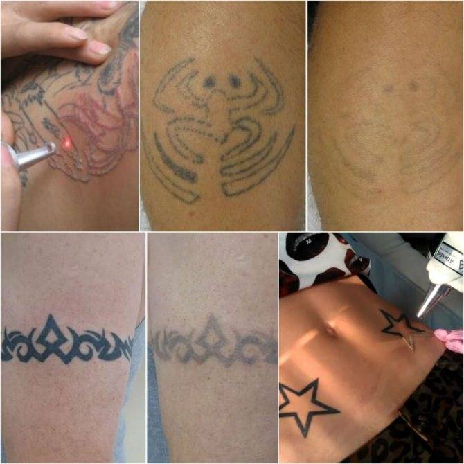 Химическое удаление татуировки на бедре - вирсавия
