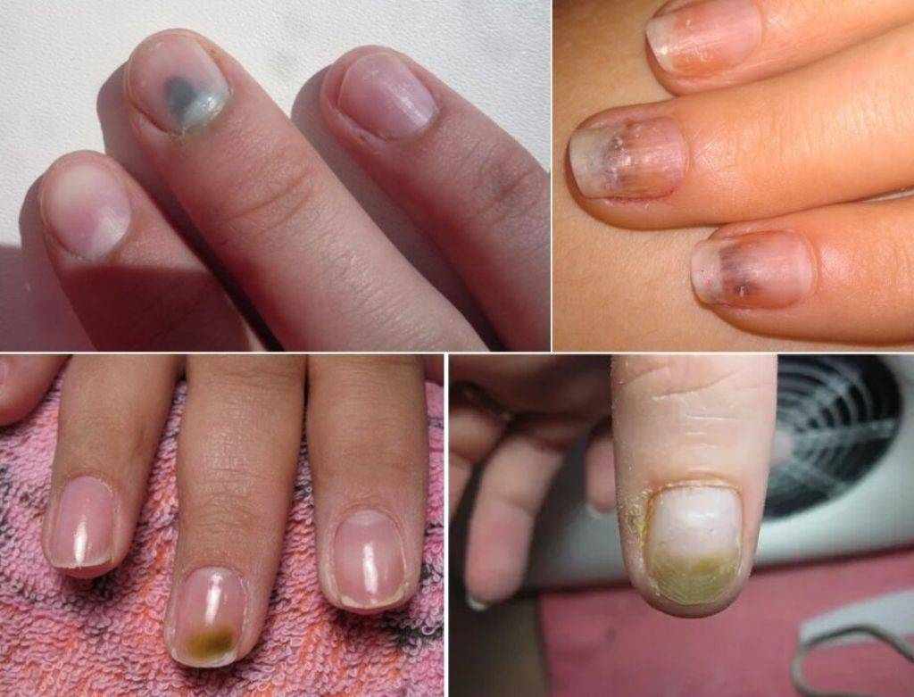 Узнайте, как восстановить ногти после наращивания быстрее всего! | красивые ногти - дополнение твоего образа