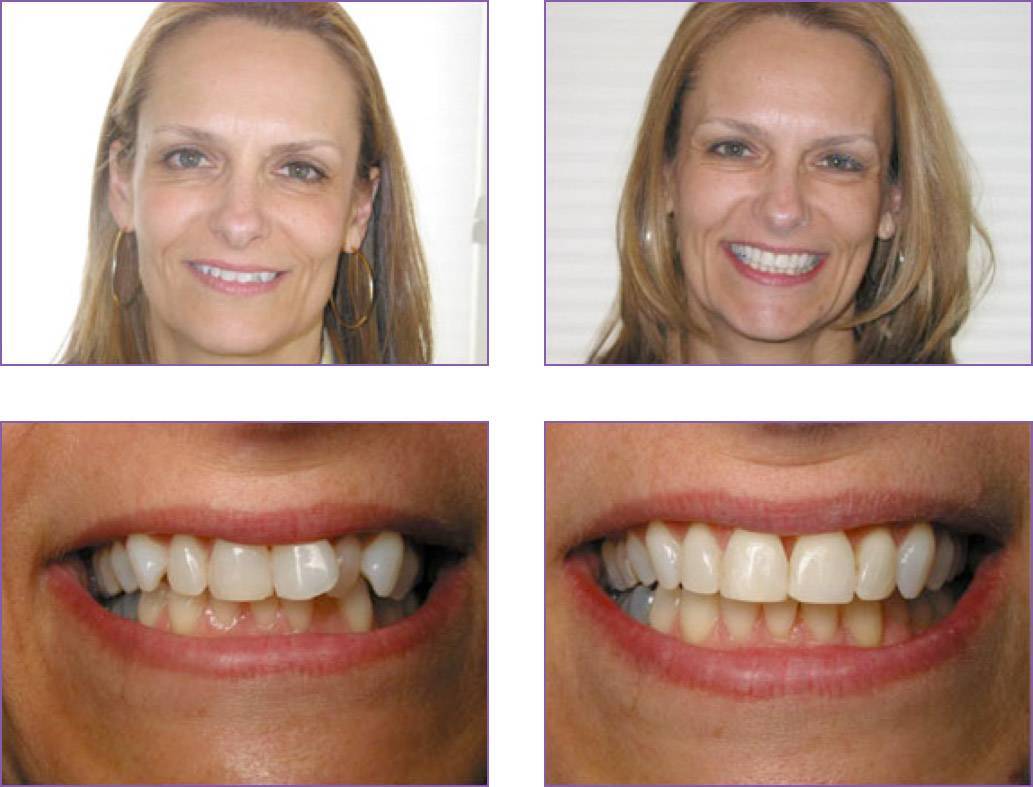 Неправильный прикус и кривые зубы — стоматология «все свои!» — официальный сайт