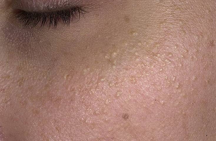 Гусиная кожа: причины, симптомы фолликулярного гиперкератоза | блог expert clinics