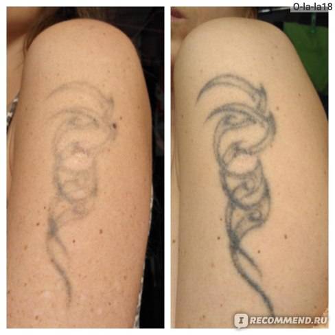 Удаление тату возможно без шрамов - как свести татуировку