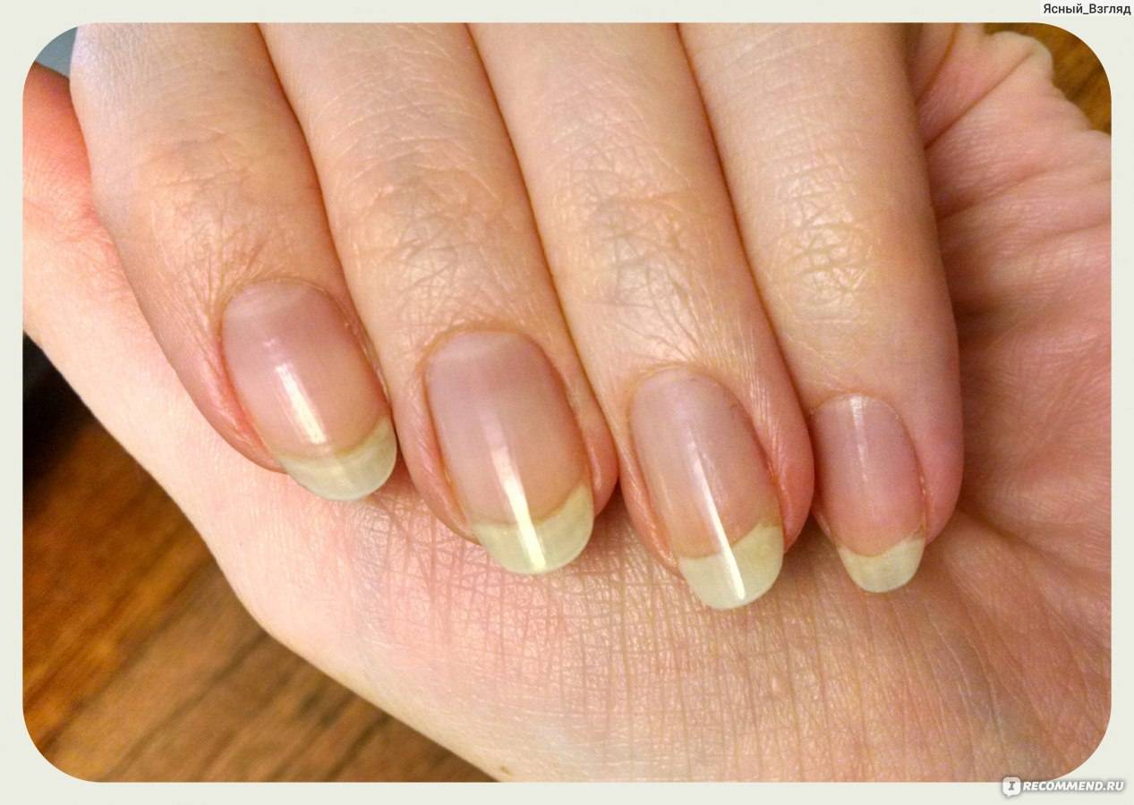Желтые ногти и все о том как их отбелить в домашних условиях