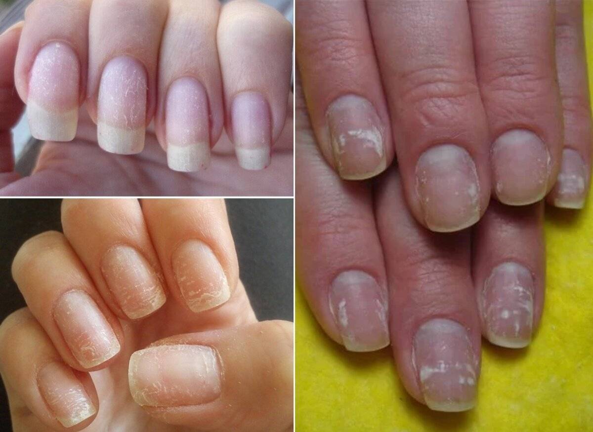 Как восстановить ногти после наращивания?!
