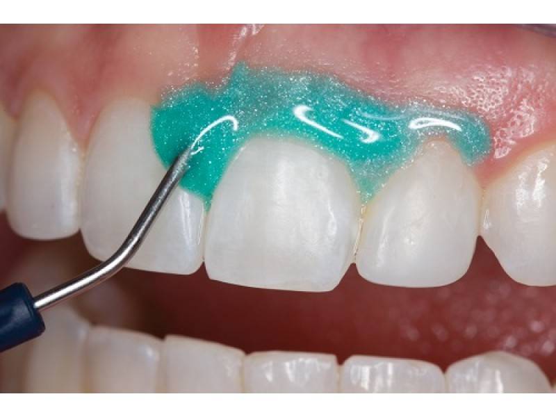 Методы отбеливания зубов в стоматологии