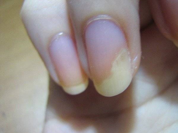 Признаки и способы лечения ушиба ногтевой пластины
