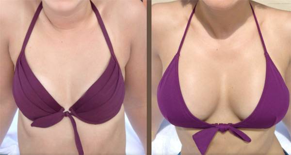 Об объёмах, формах и профилях имплантов для увеличения груди