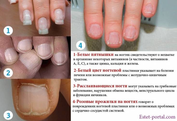 Почему ногти становятся бугристыми, волнистыми и ребристыми? причины деформации, лечение и профилактика проблемы