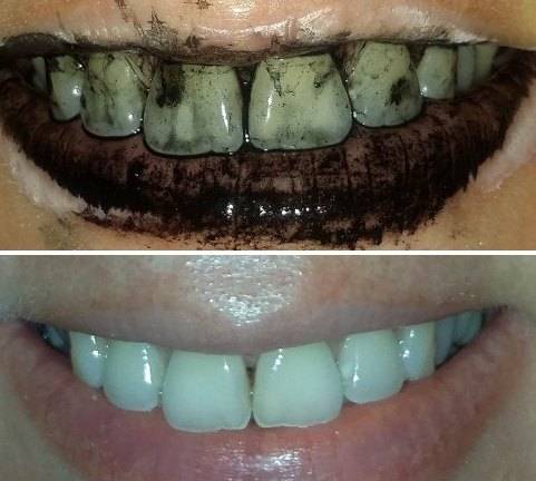 Отбеливание зубов активированным углем: преимущества и эффективность