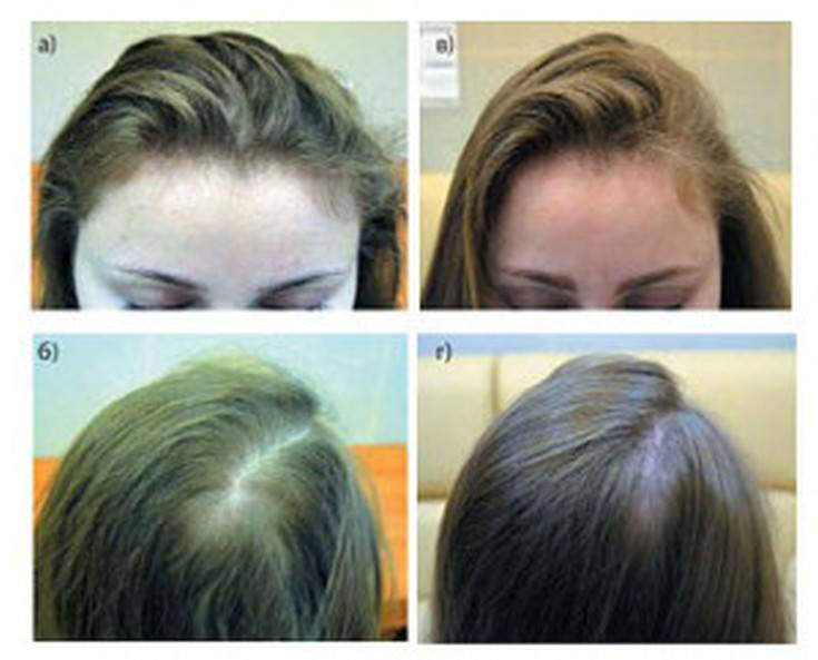Плазмолифтинг для волос: в чем заключается польза плазмы для роскошной шевелюры