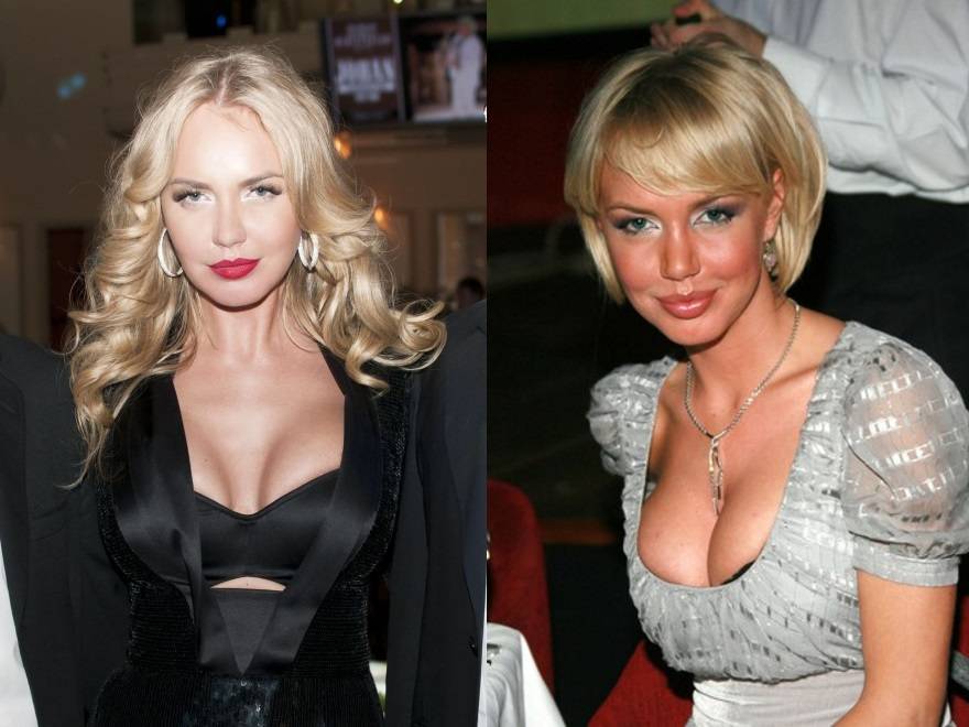 Российские звезды до и после пластики на фото