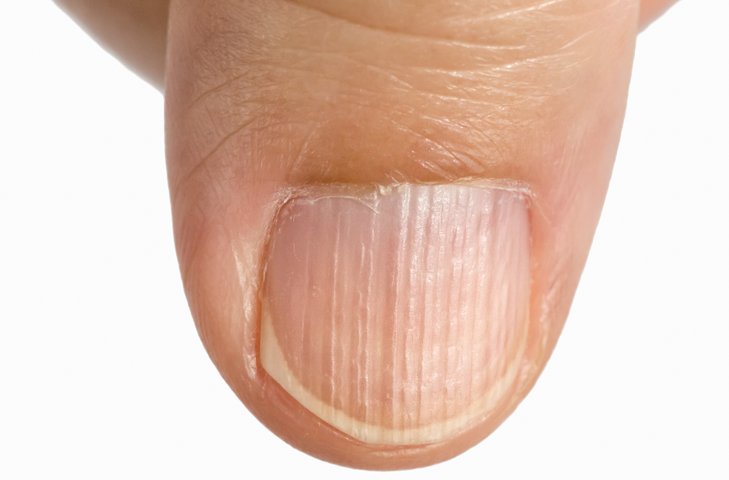 Почему на ногтях появляются продольные и поперечные бороздки: причины и лечение