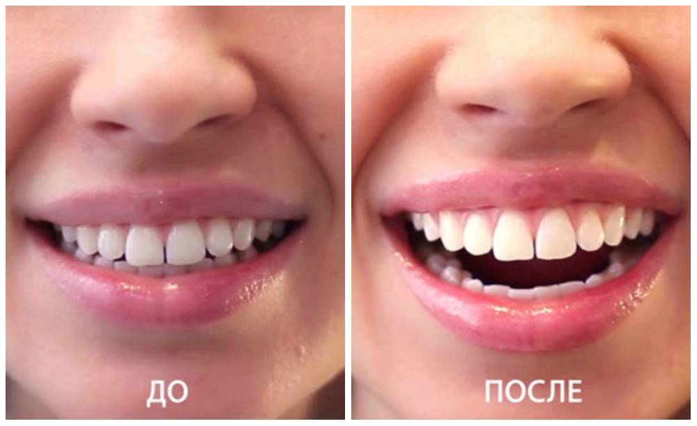 Отбеливание зубов zoom (зум): плюсы и минусы
