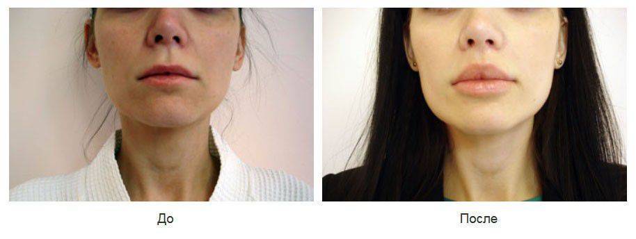 Липофилинг губы фото до и после