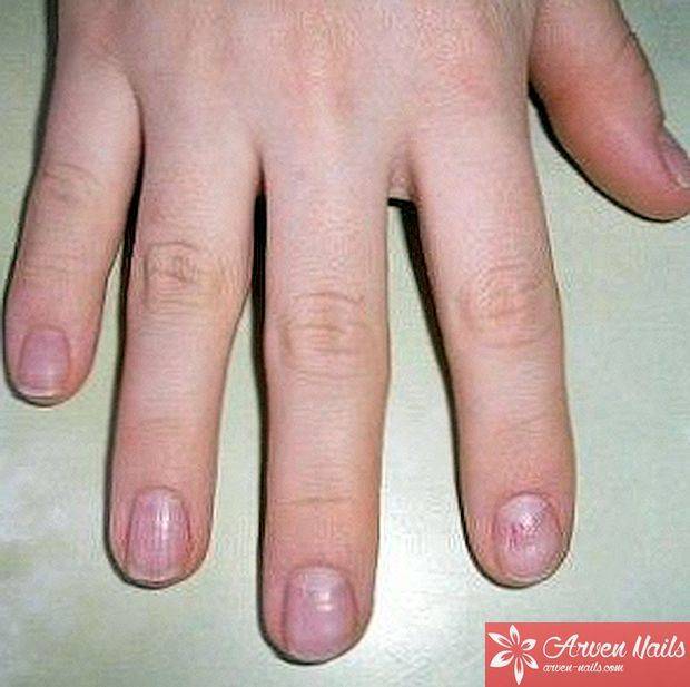 Посинение ногтей на руках и ногах. причины, болезнь и лечение