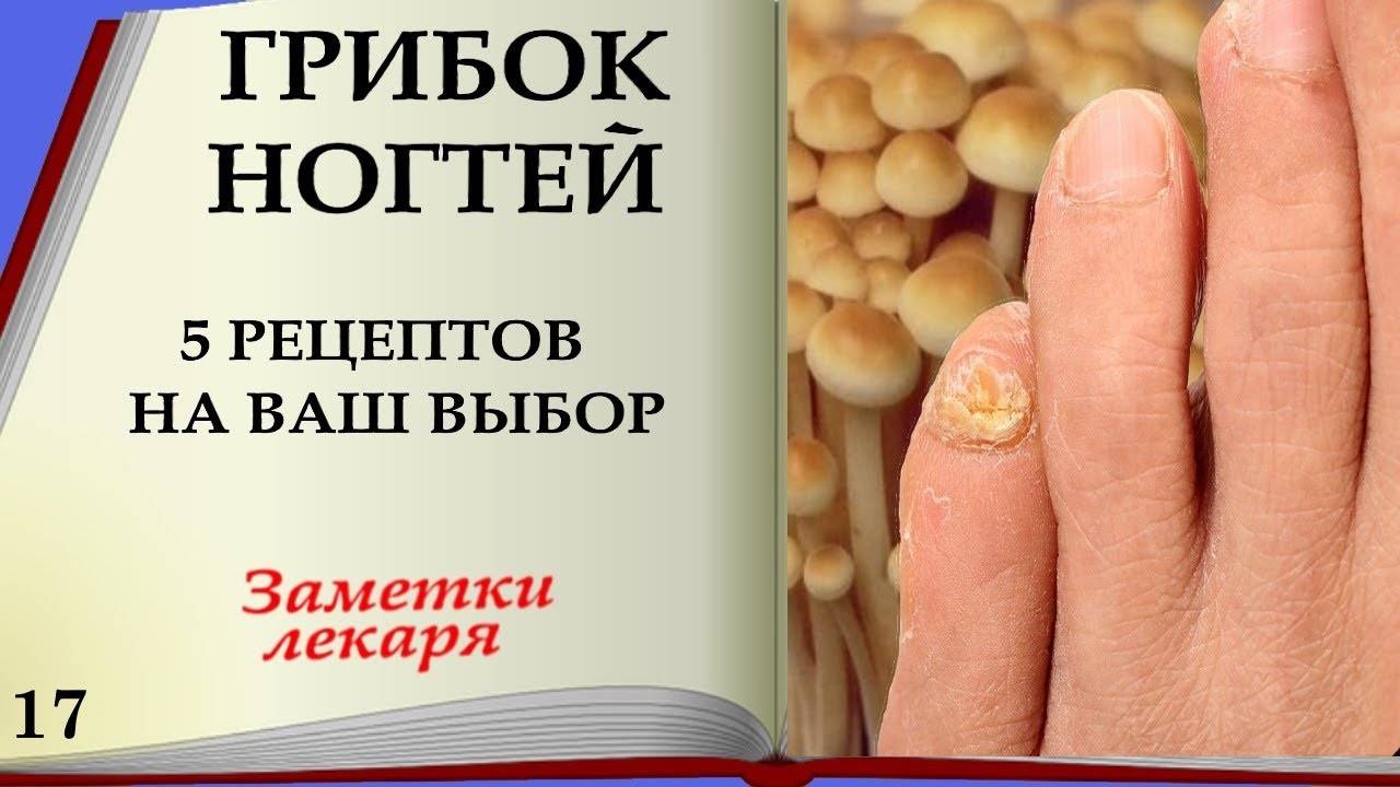 Народные средства лечения грибка ногтей на ногах - народные рецепты