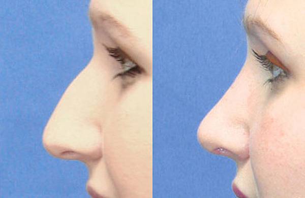 Как исправить кривой нос – статьи института красоты галактика
