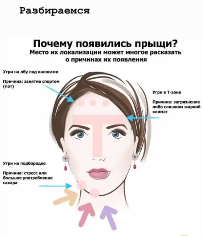 Прыщи на висках: причины, виды, о чем говорят, как избавиться