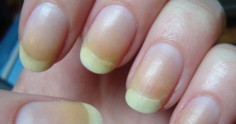 От чего желтеют ногти: возможные причины