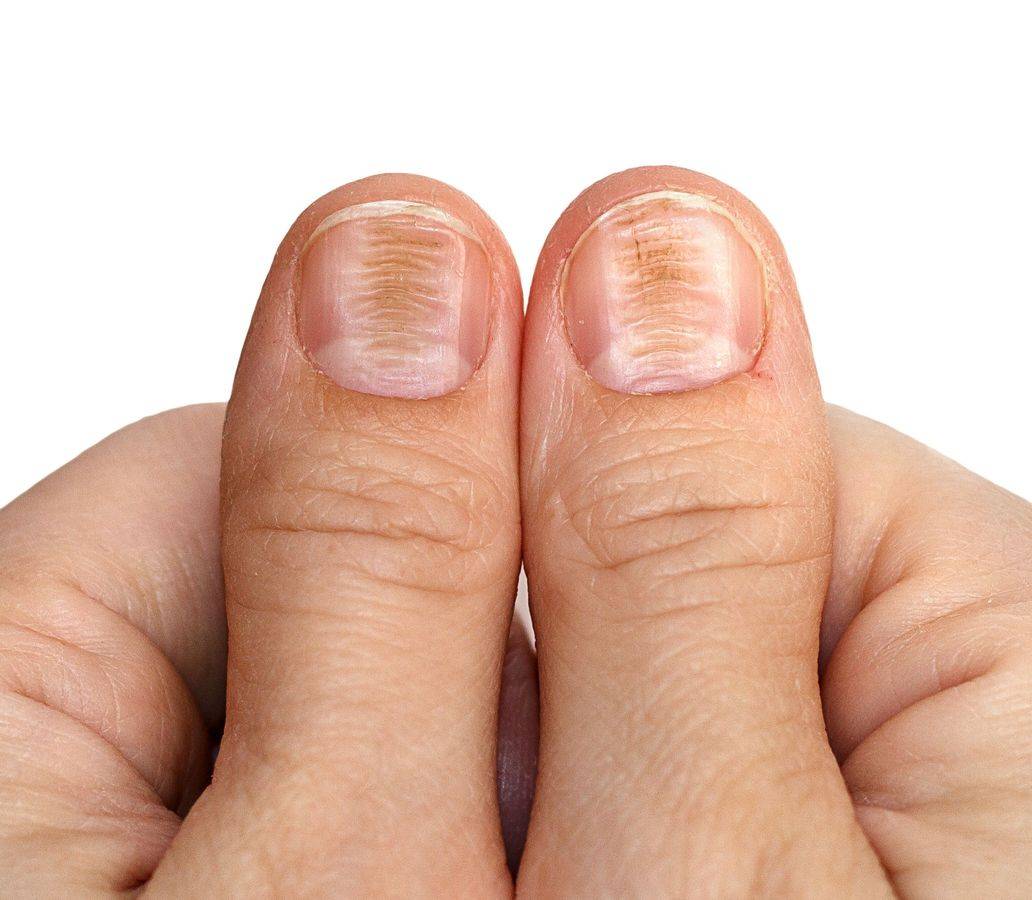 Дистрофические изменения ногтей