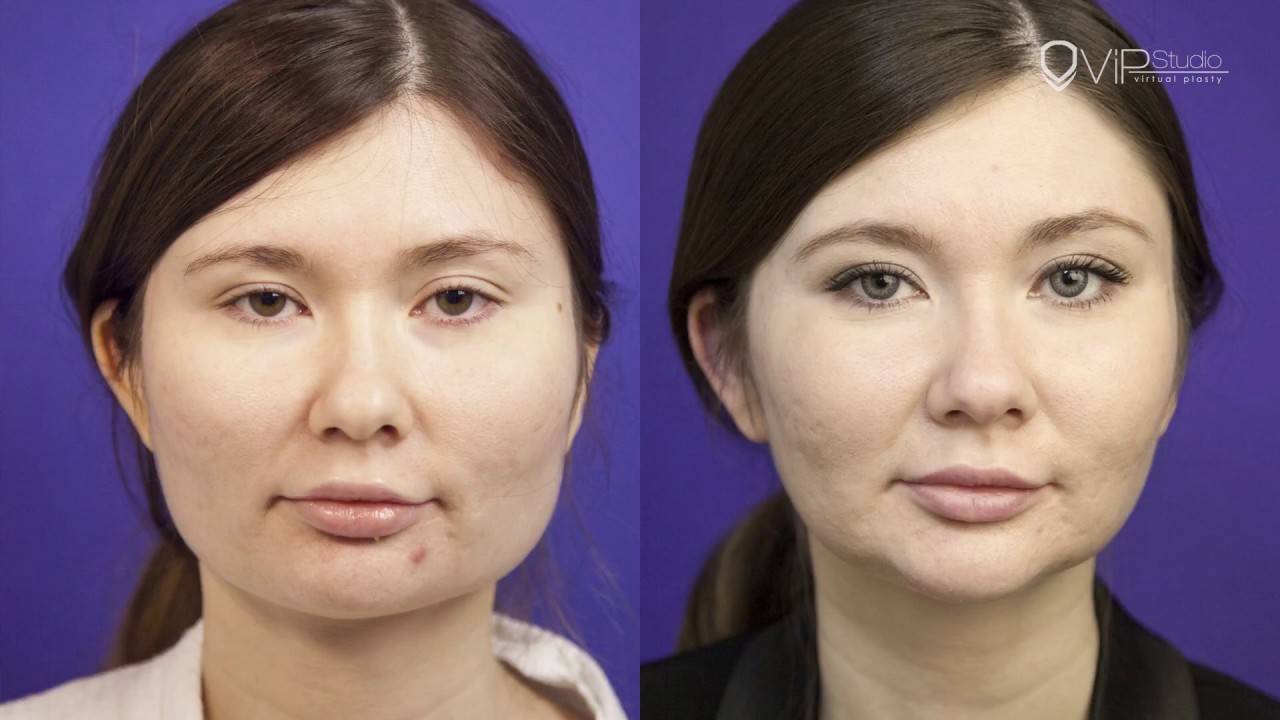 Какие пластические операции помогут исправить форму лица?
