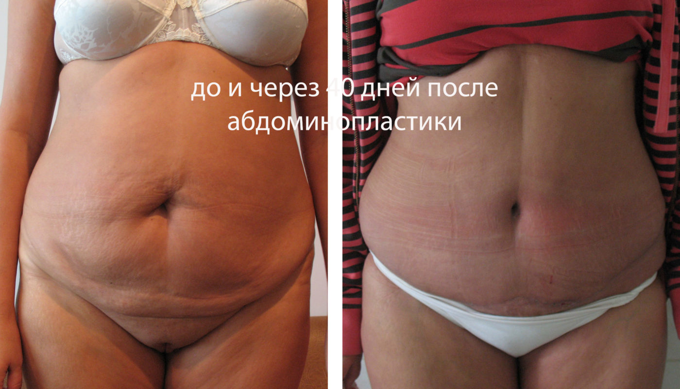 Классическая абдоминопластика — фото до и после операции в клинике эталон | рассрочка от 8000 руб./месяц