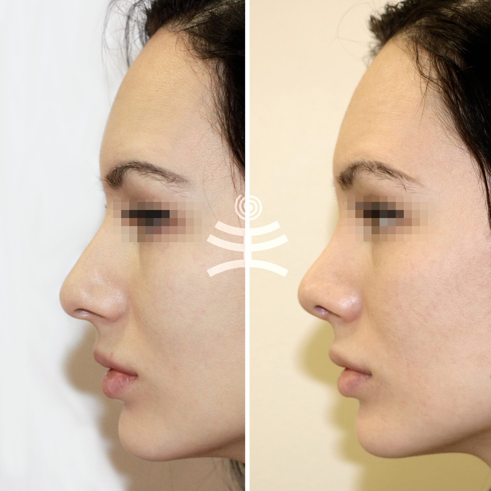 Ринопластика широкого носа: особенности операции