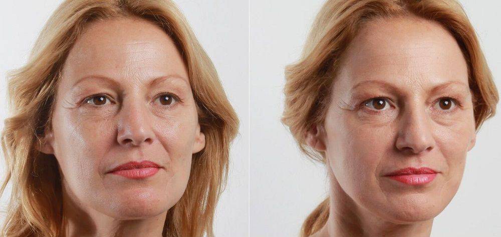 Холодная плазма для лица фото до и после в косметологии