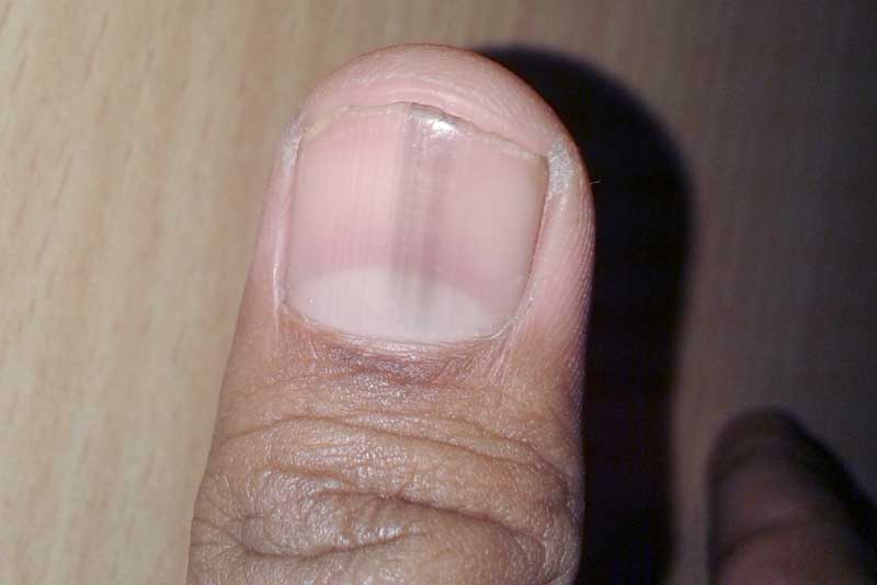 Черные полоски на ногтях рук - причины и лечение