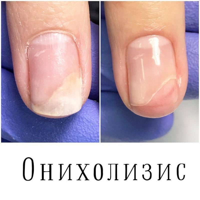 Онихолизис ногтей: причины, симптомы, диагностика, лечение – эл клиника