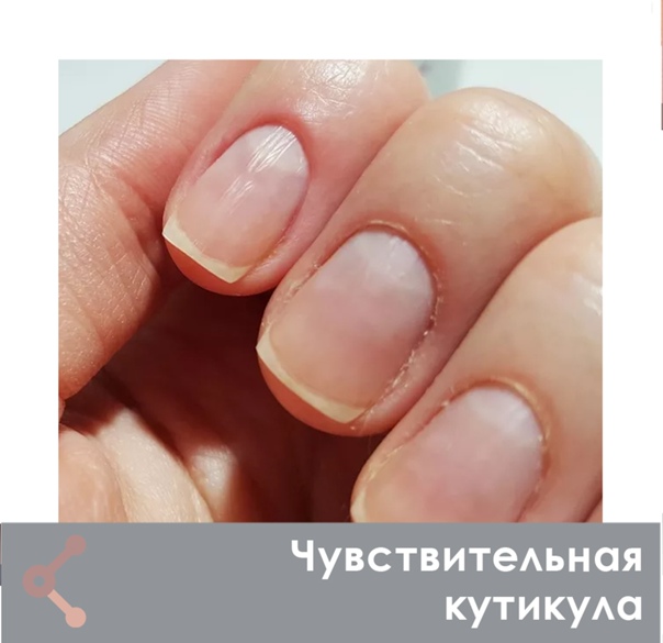 Близкое расположение сосудов: особенности выбора маникюра и ухода за кутикулой