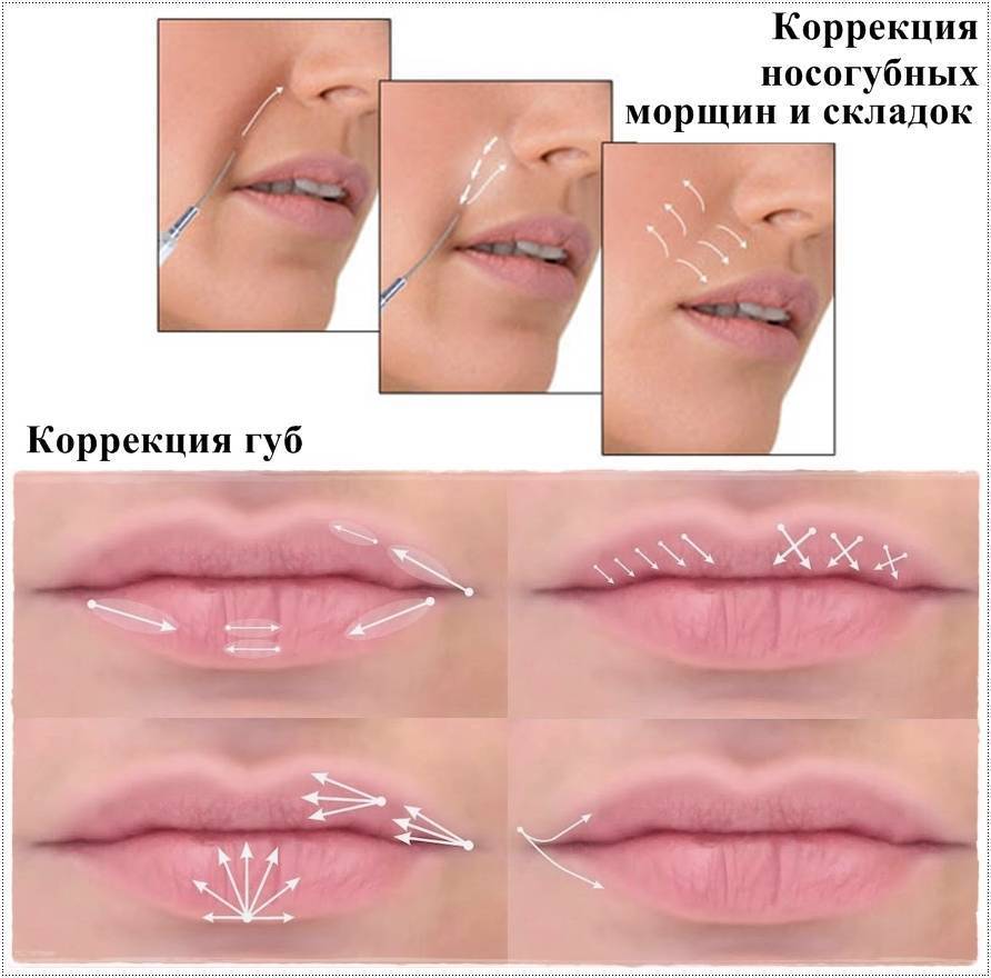 Коррекция опущенных уголков губ