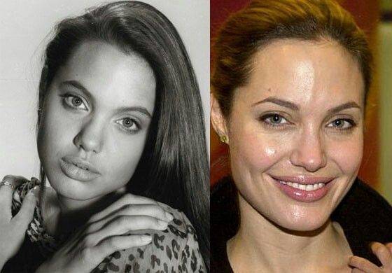 Анджелина джоли после операции: фото до и после пластики