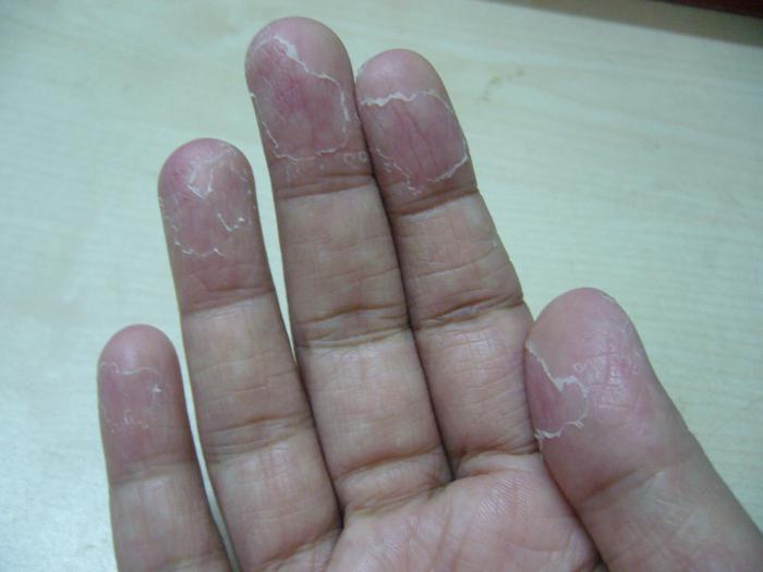 Почему трескается кожа на руках | блог expert clinics