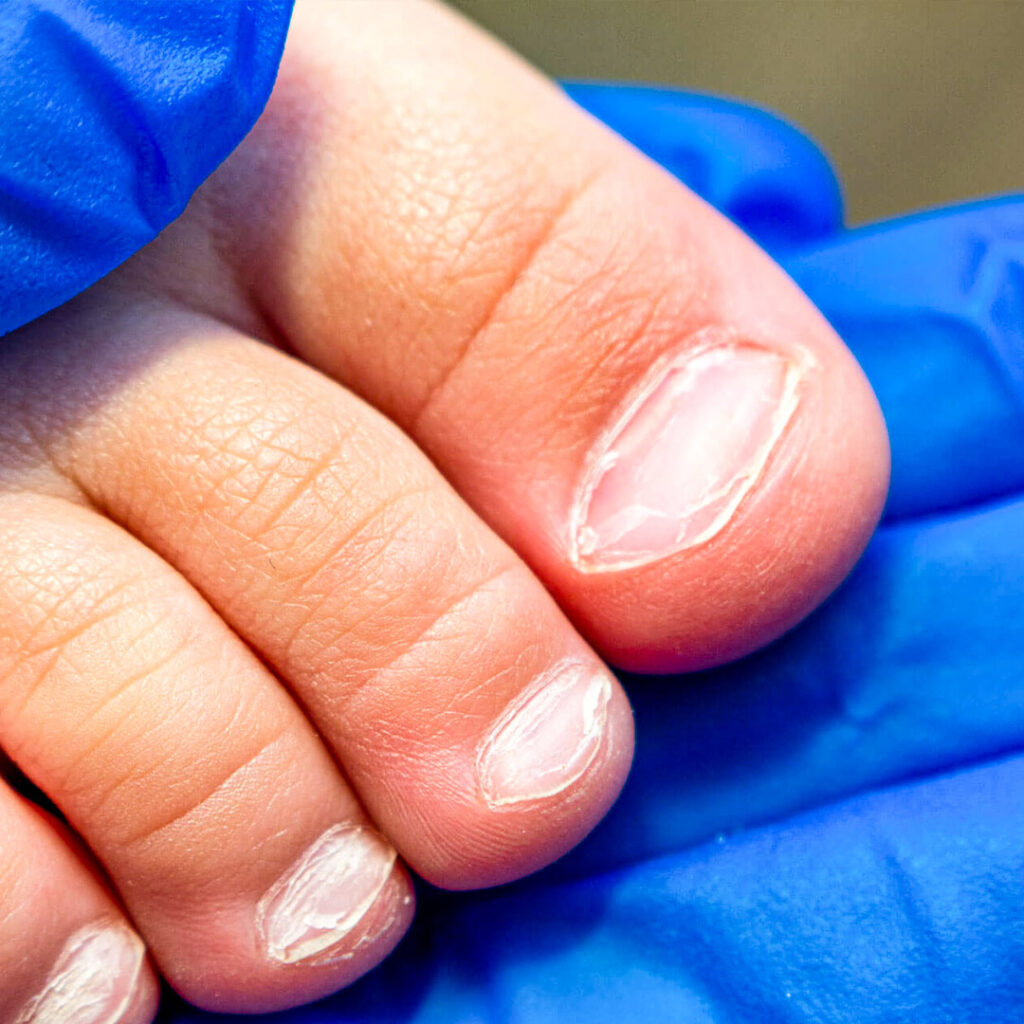 Потемнения на ногтях: причины и как устранить