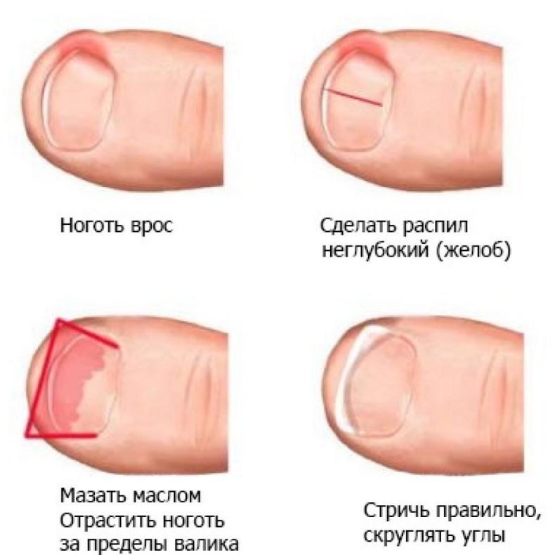 Лечение травмы ногтя: советы медиков | красивые ногти - дополнение твоего образа