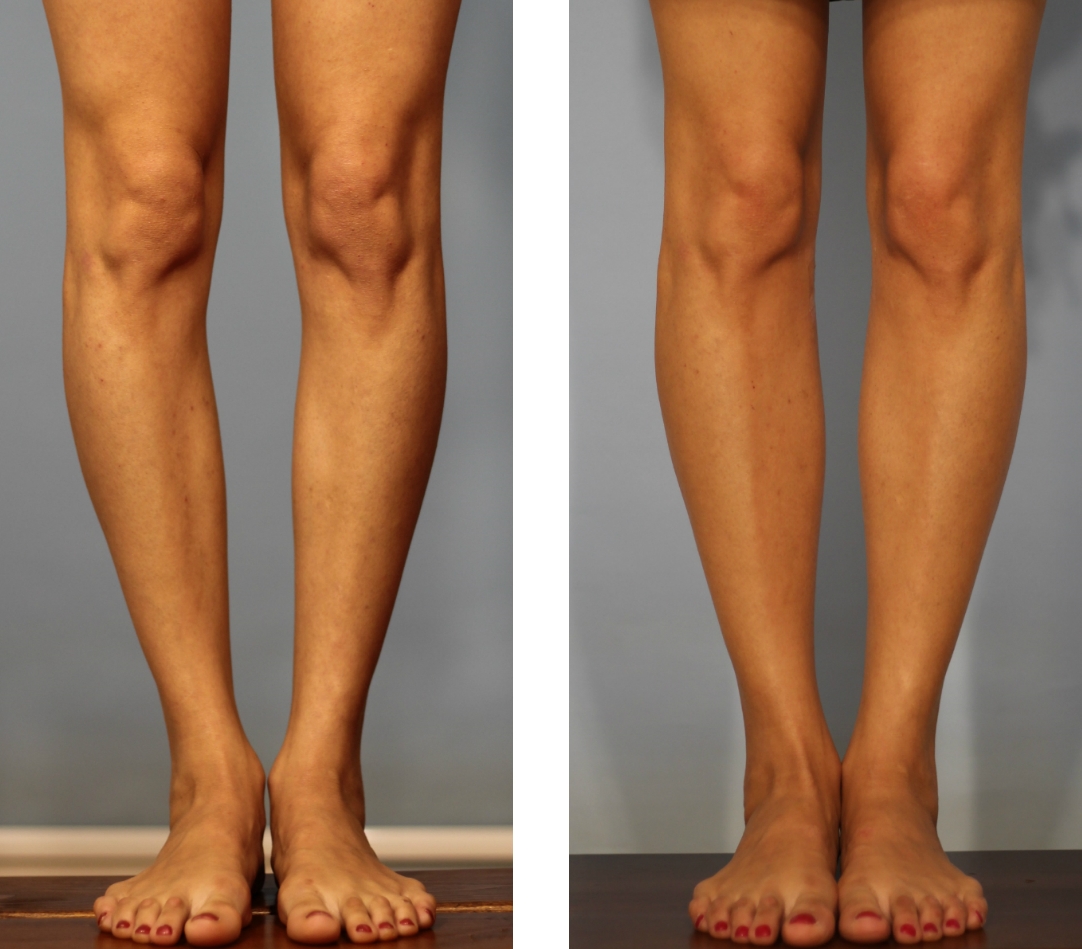 Кривые ноги- как исправить? какие упражнения нужно выполнять, чтобы ноги стали ровными? какую одежду носить? пути решения деликатной проблемы +видео